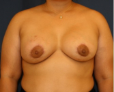 Feel Beautiful - Breast Augmentation Lift 53 - After Photo